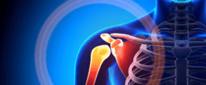 shoulder replacement surgery