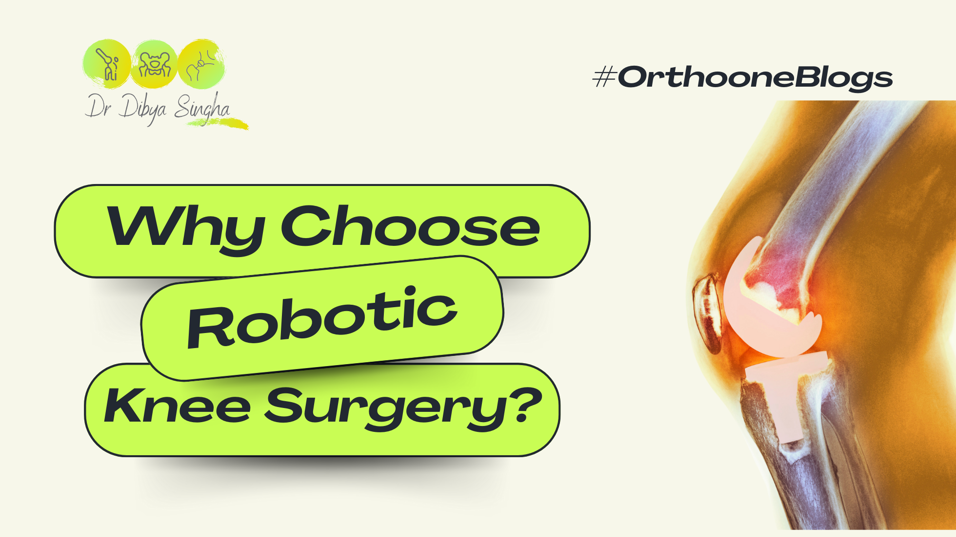 Why Choose Robotic Knee Surgery Instead of Open Knee Surgery?